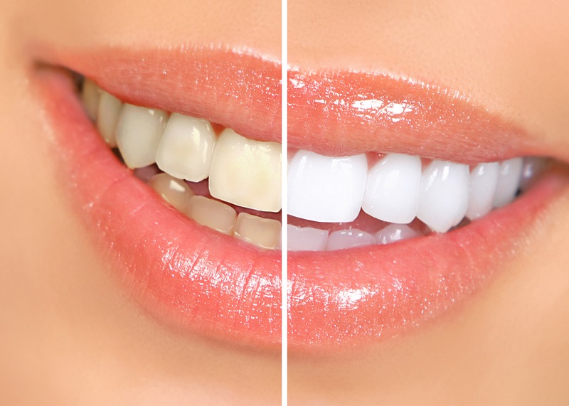 cosmetic dentistry - dentist Cape Town