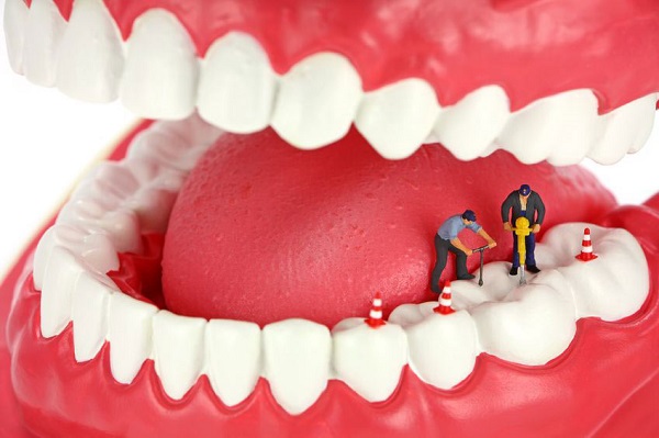 Root Canal, a necessity to save your teeth.