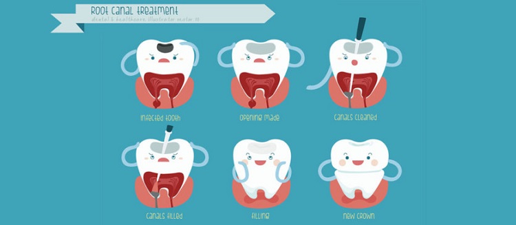 Root Canal Illustration  - Dentist Clarmeont