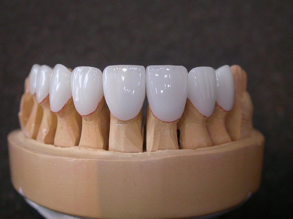 Get a Quote for a Beautiful Smile with Veneers