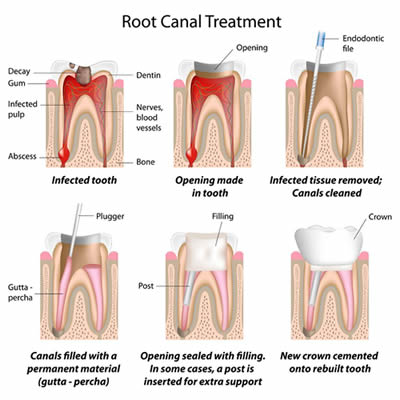 Dentist Claremont Cape Town Root Canal Treatment